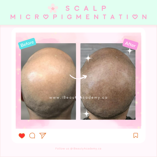 ☘️ Scalp Micropigmentation CAD $300 – $2000