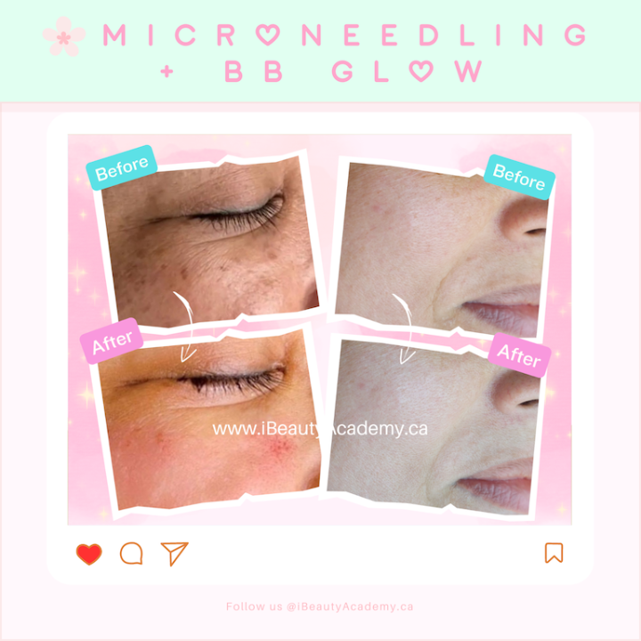 ☘️ Korean Microneedling + BB Glow Skin Treatment - PMU, Numbing Cream & Beauty Products to Canada | USA | Australia | Austria | Denmark | UK | France | Germany | Ireland | Italy | Netherlands | New Zealand... # #